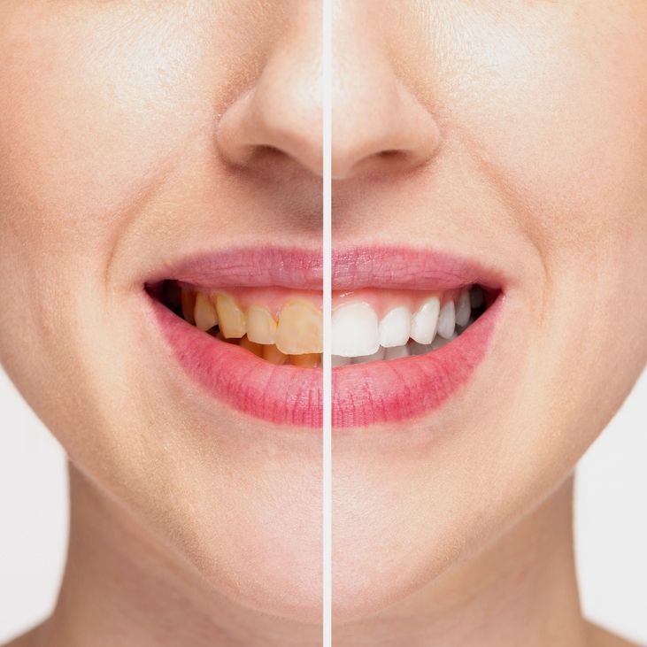 Scaling/Teeth Cleaning
